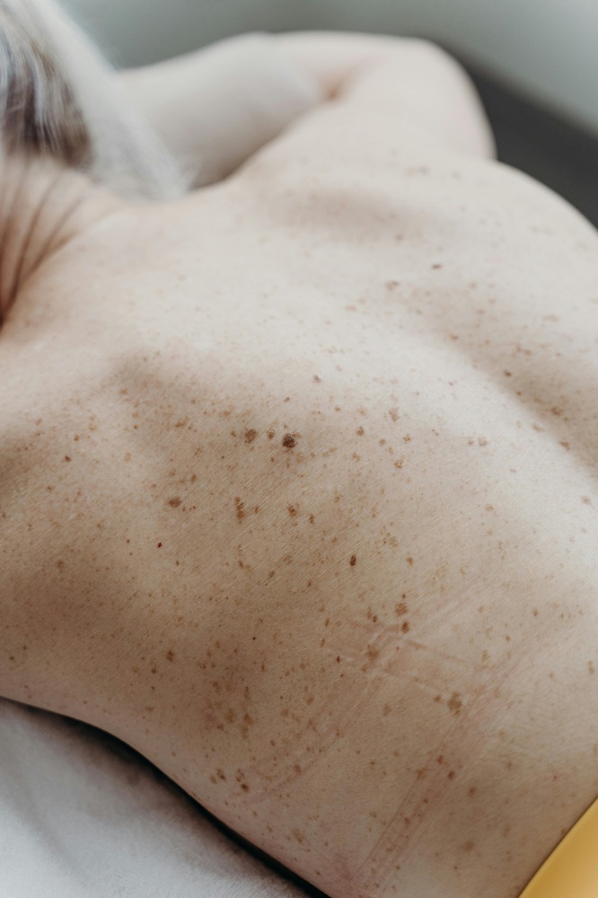 Freckled back.