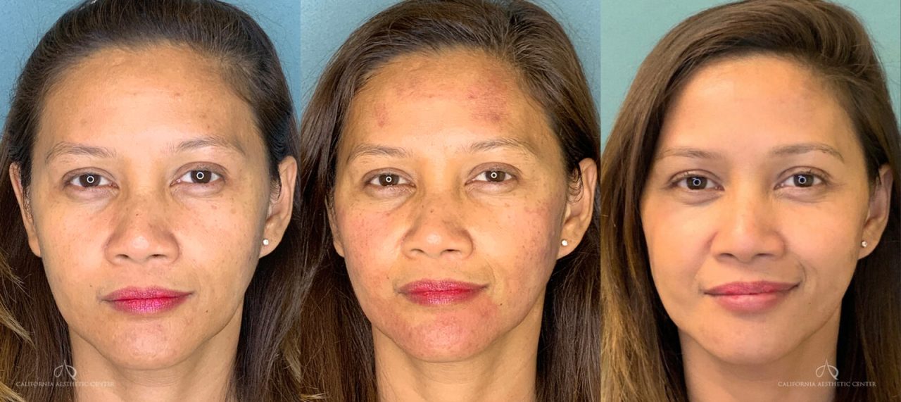 SteveVu_IPL_Photofacial_Beforeandafter_Side_Patient2